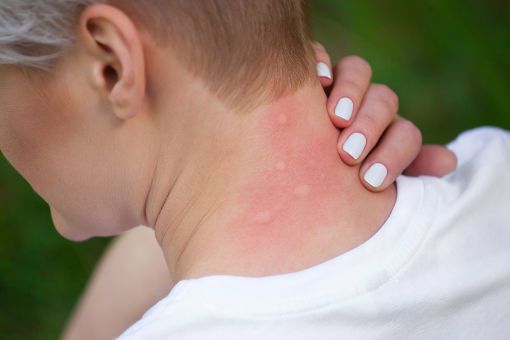 Alergii la intepaturi de insecte: Simptome, tratament si preventie