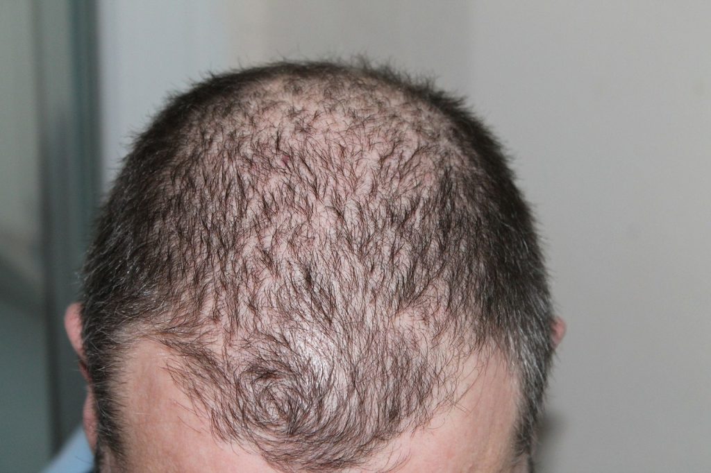 Suc de ceapa pentru alopecie