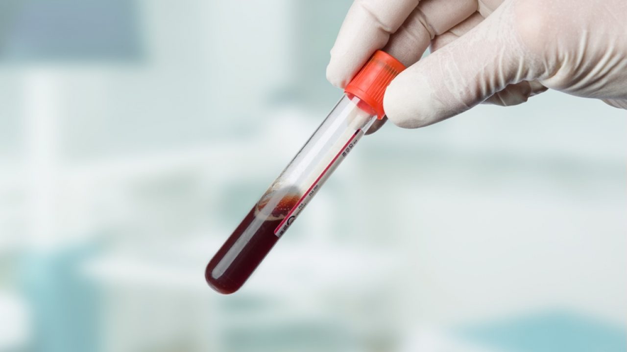 sânge în timpul urinării la bărbați