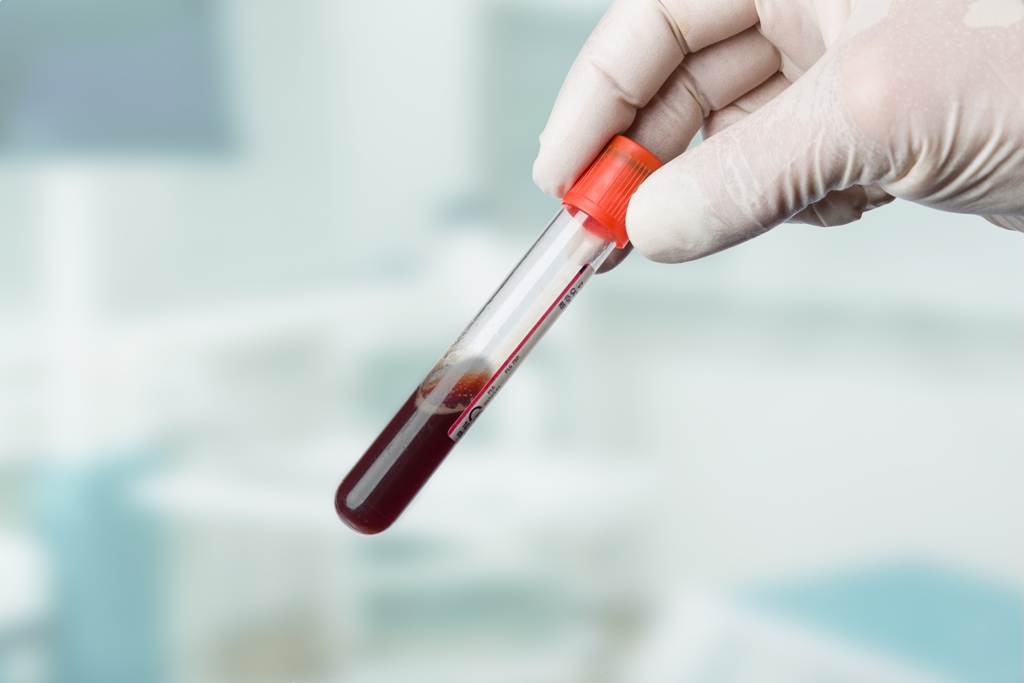 Hematuria (sânge în urină): cauze, investigații și diagnostic – casadeculturacluj.ro