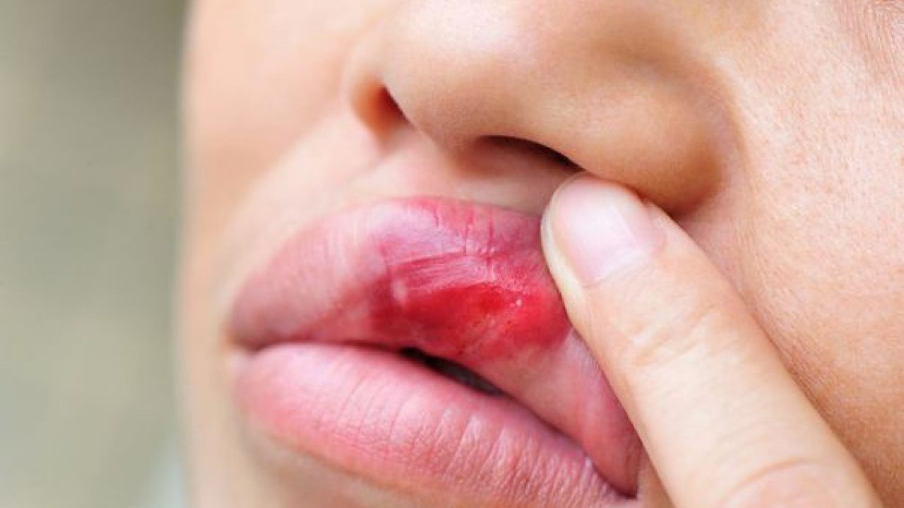Guta - boala metabolica pentru care exista tratament