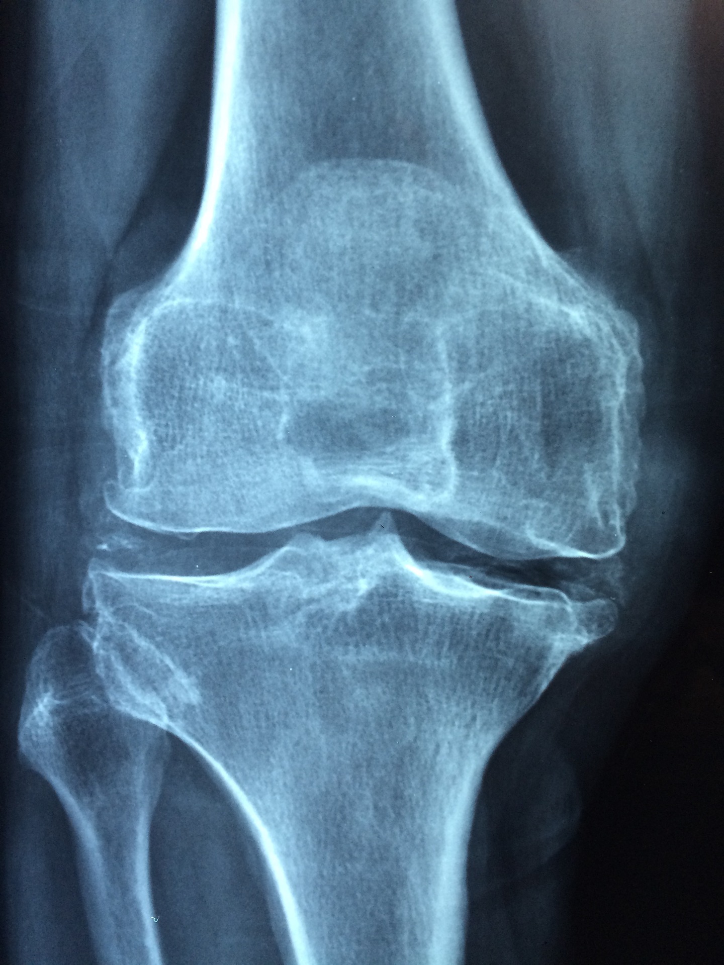 osteonecroza spontană a tratamentului articulației genunchiului