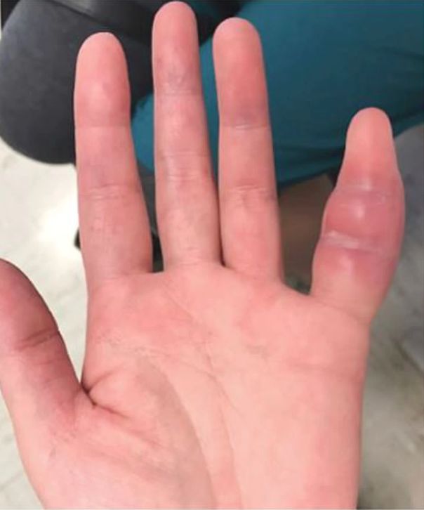 Monturile (hallux valgus): cauze, simptome si tratament - i-cazari.ro